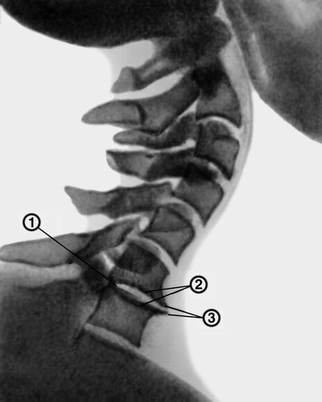 Kakla mugurkaula rentgenogrāfija ar osteohondrozi