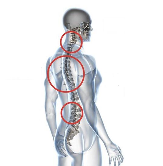 Kā izpaužas osteohondroze