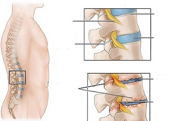 disku izmaiņas osteohondrozes dēļ