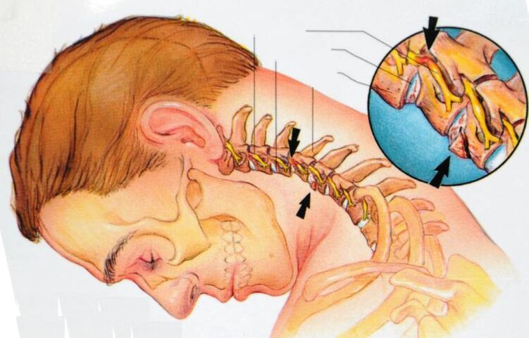 dzemdes kakla osteohondrozes simptomi