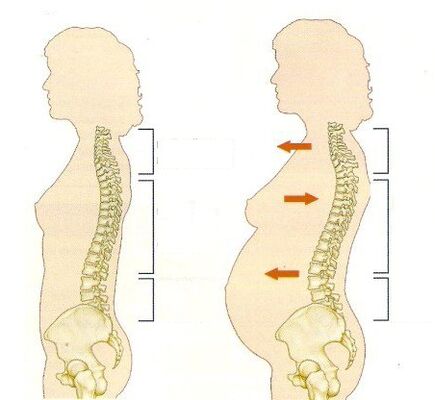 osteohondroze grūtniecības laikā